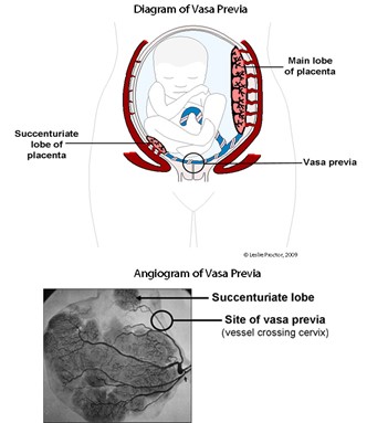 vasa previa placenta lobe succenturiate